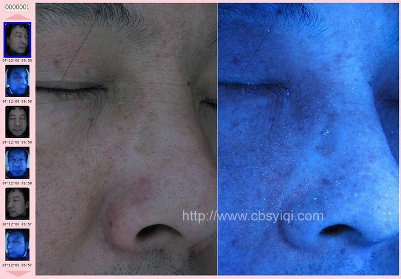 電腦魔鏡儀,面部CT皮膚分析系統(tǒng)圖片/電腦魔鏡儀,面部CT皮膚分析系統(tǒng)樣板圖 (4)